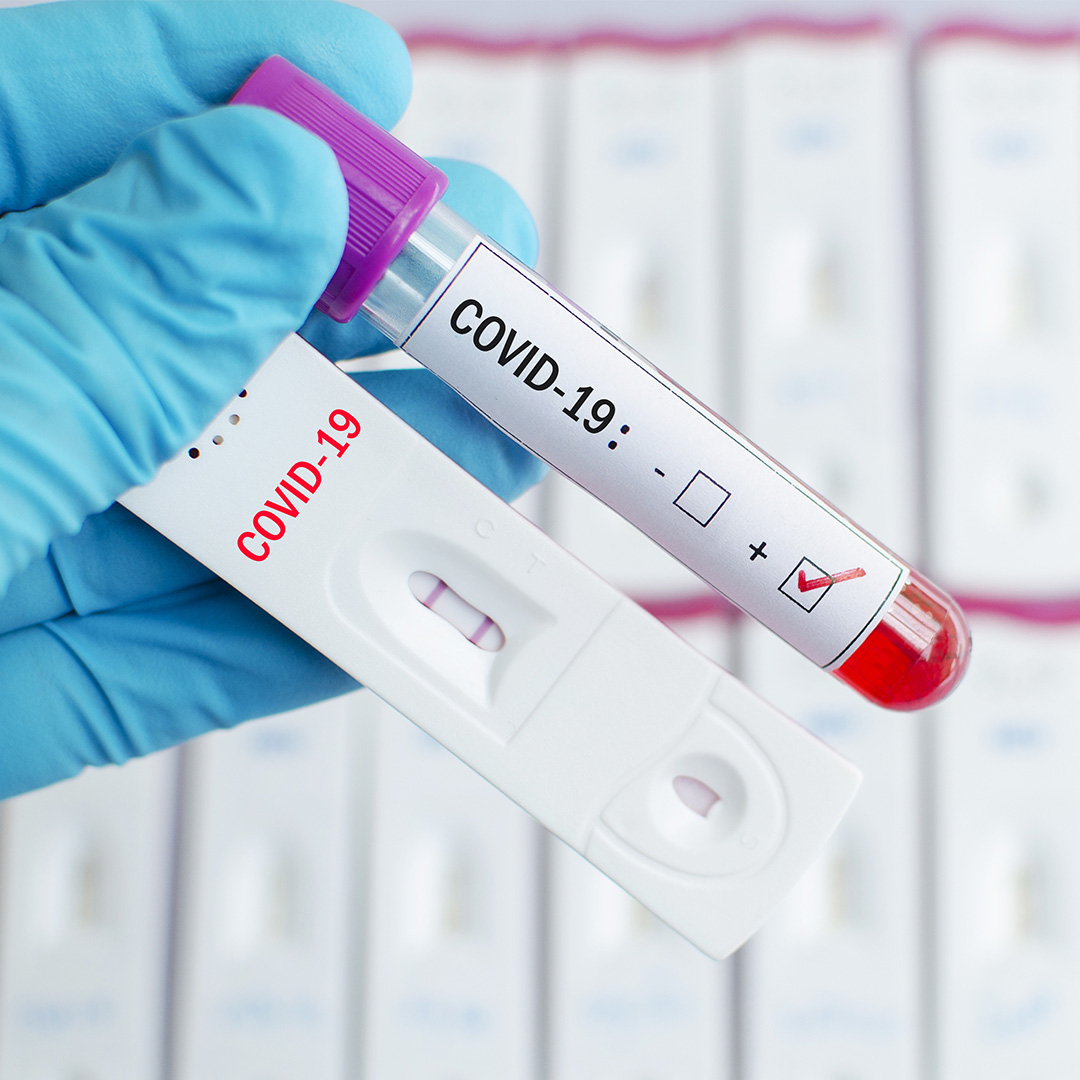Бързи тестове за антитела за коронавирус